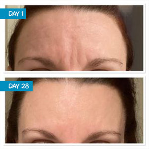 Before and after photo of a woman's forehead showing the effect MooGoo's Amplified Anti-Ageing Peptide Active Serum 25ml has on the face. her skin roughness, radiance, firmness, elasticity, and facial volume is improved.