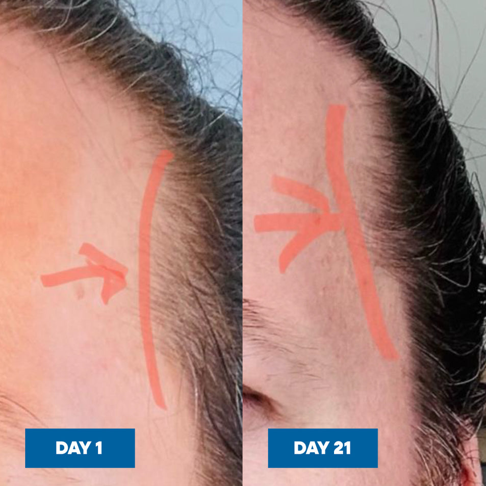 Before and after comparison of hair growth on a person's head with red arrows indicating growth over 21 days.