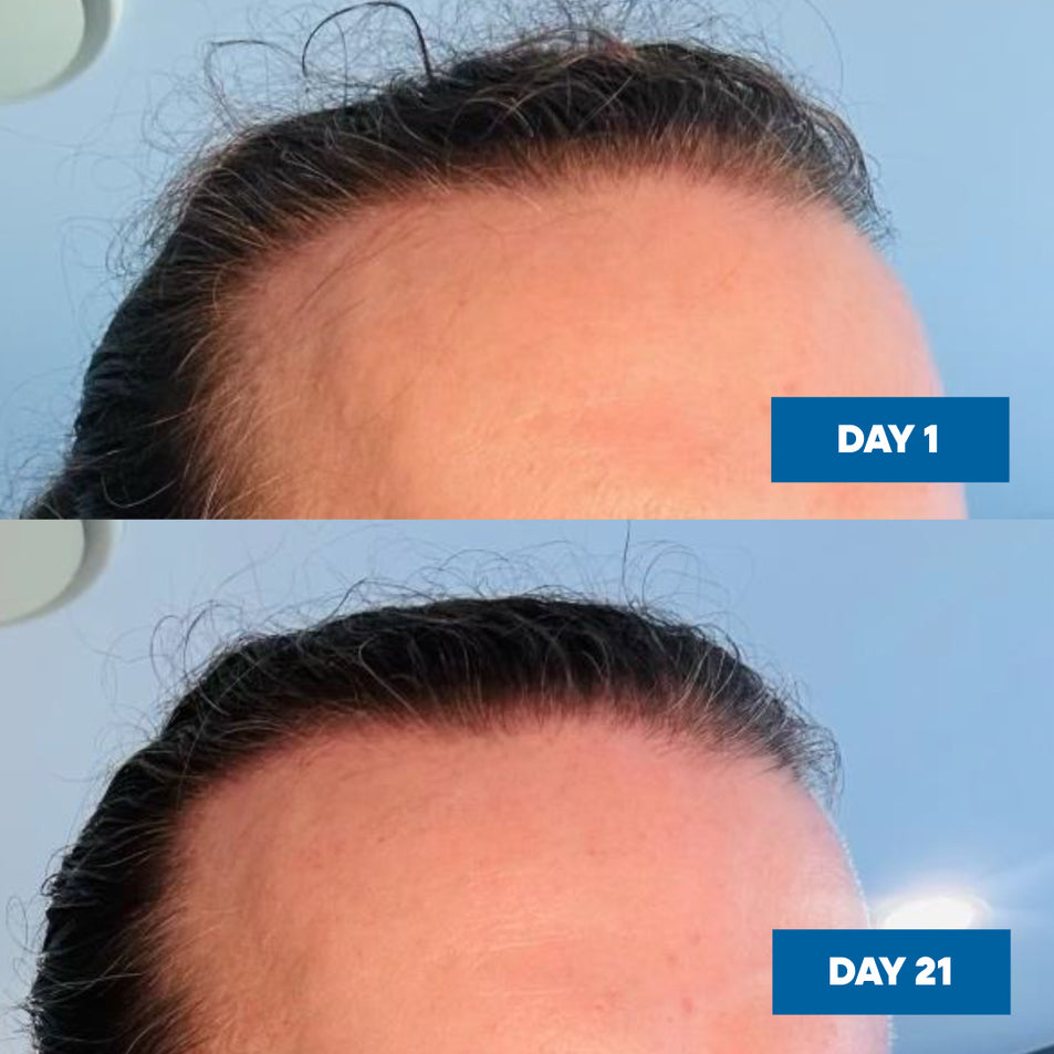 A before-and-after comparison of a person's scalp and hairline, showing hair growth progress from DAY 1 to DAY 21. 